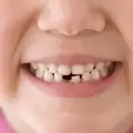 Индийка на 7 години живяла с 202 зъба