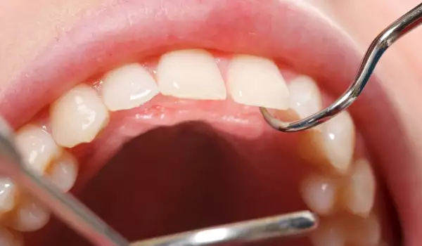 Кътен зъб