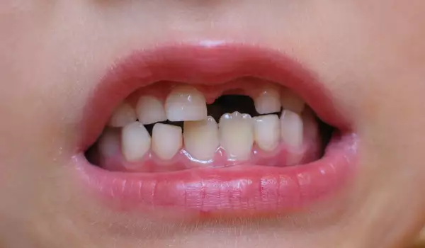 Млечни зъби