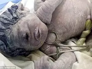 Новородено само с 1 око доказа, че циклопи са съществували