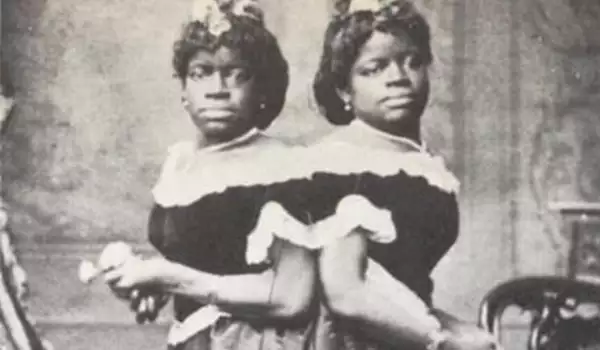 Трогателната история на сиамските близначки от Северна Каролина