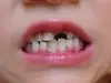 Млечни зъби